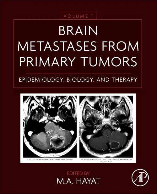 Coperta cărții "Brain Metastases from Primary Tumors Volume 1" de autor necunoscut