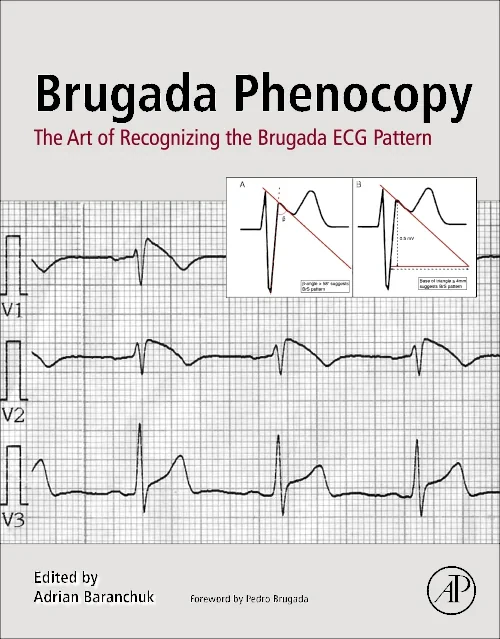 Coperta cărții "Brugada Phenocopy" de autor necunoscut