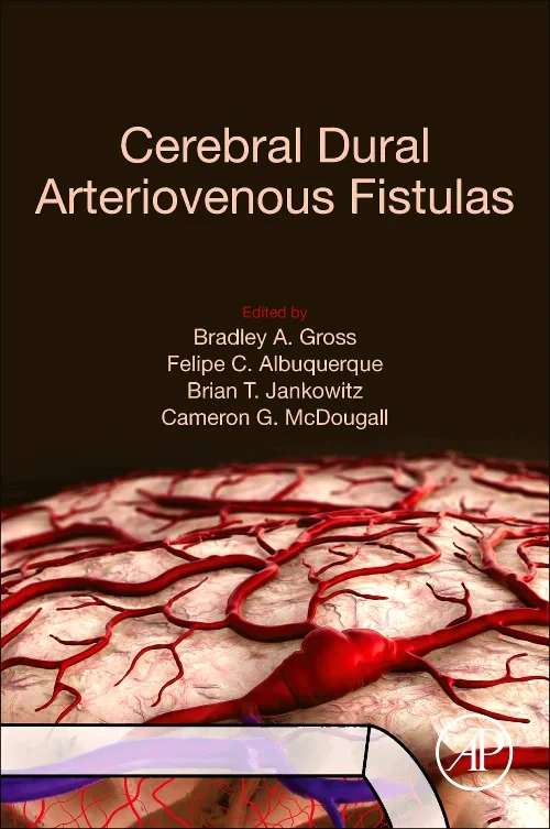 Coperta cărții "Cerebral Dural Arteriovenous Fistulas" de autor necunoscut