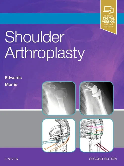 Coperta cărții "Shoulder Arthroplasty" de autor necunoscut